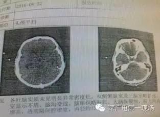 深圳男子被罕见“吃脑虫”侵入 十几天后病逝